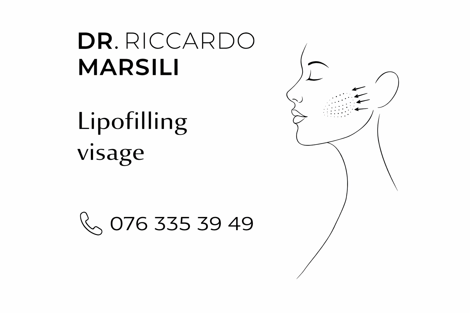 Lipofilling visage à Lausanne : rajeunir naturellement avec sa propre graisse